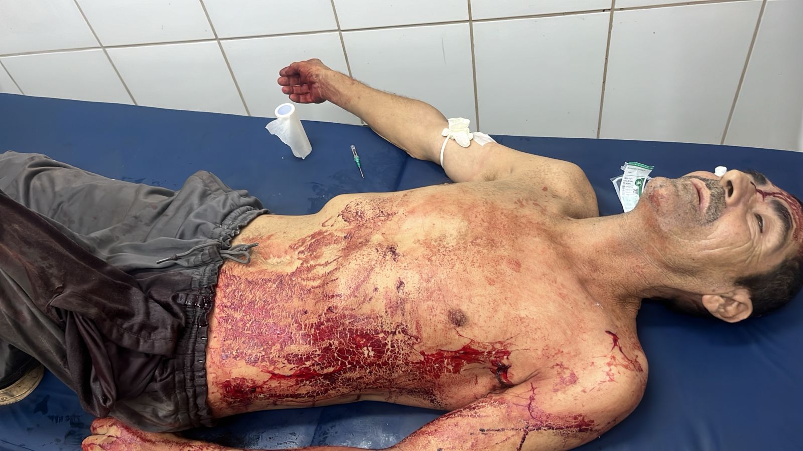 Riña entre adictos deja un herido en Pedro Juan.