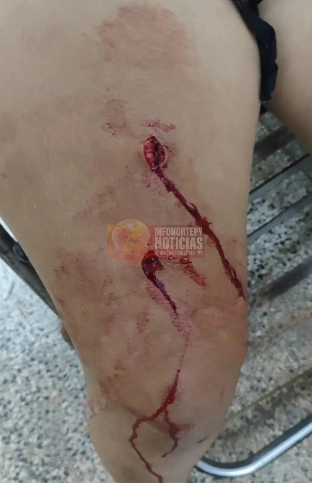 Brasileña herida en Pedro Juan por cuestión pasional