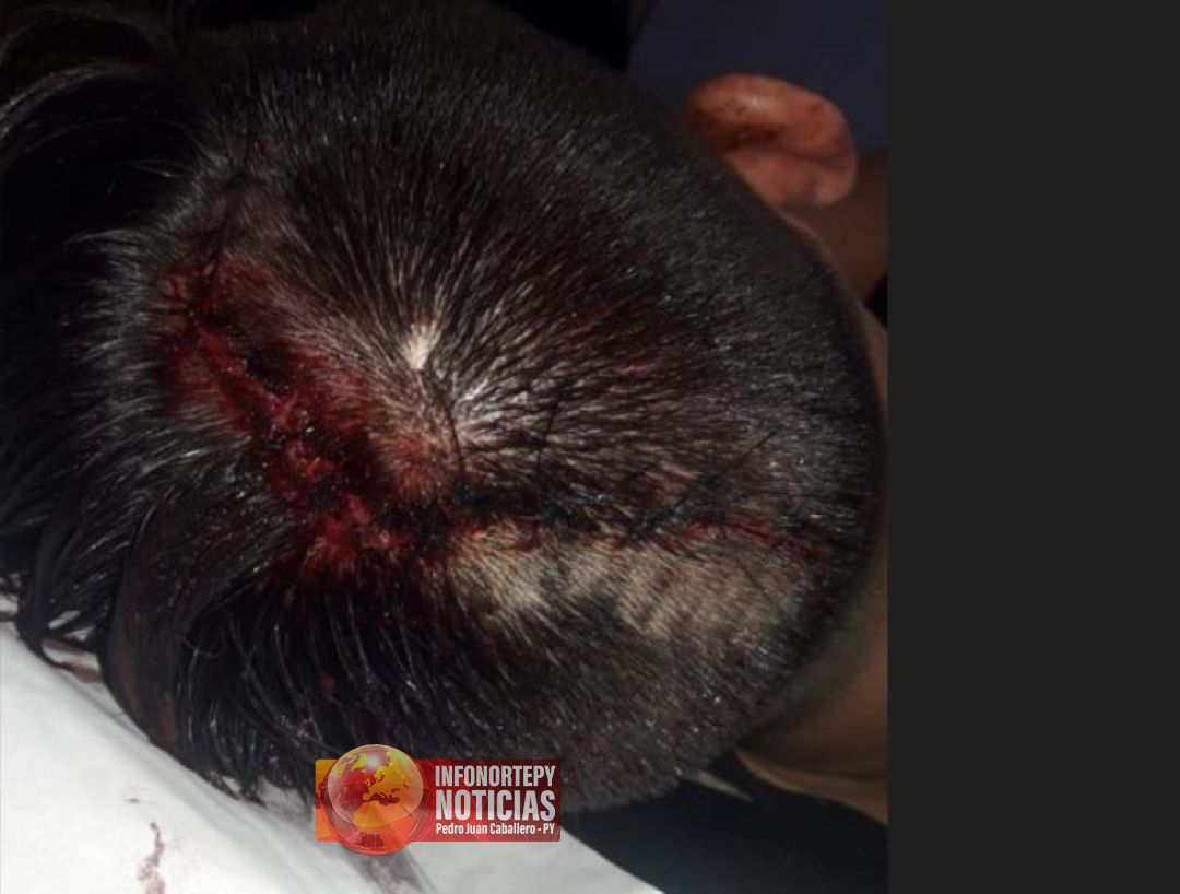 Joven quedo con traumatismo de cráneo tras accidente en Pedro Juan