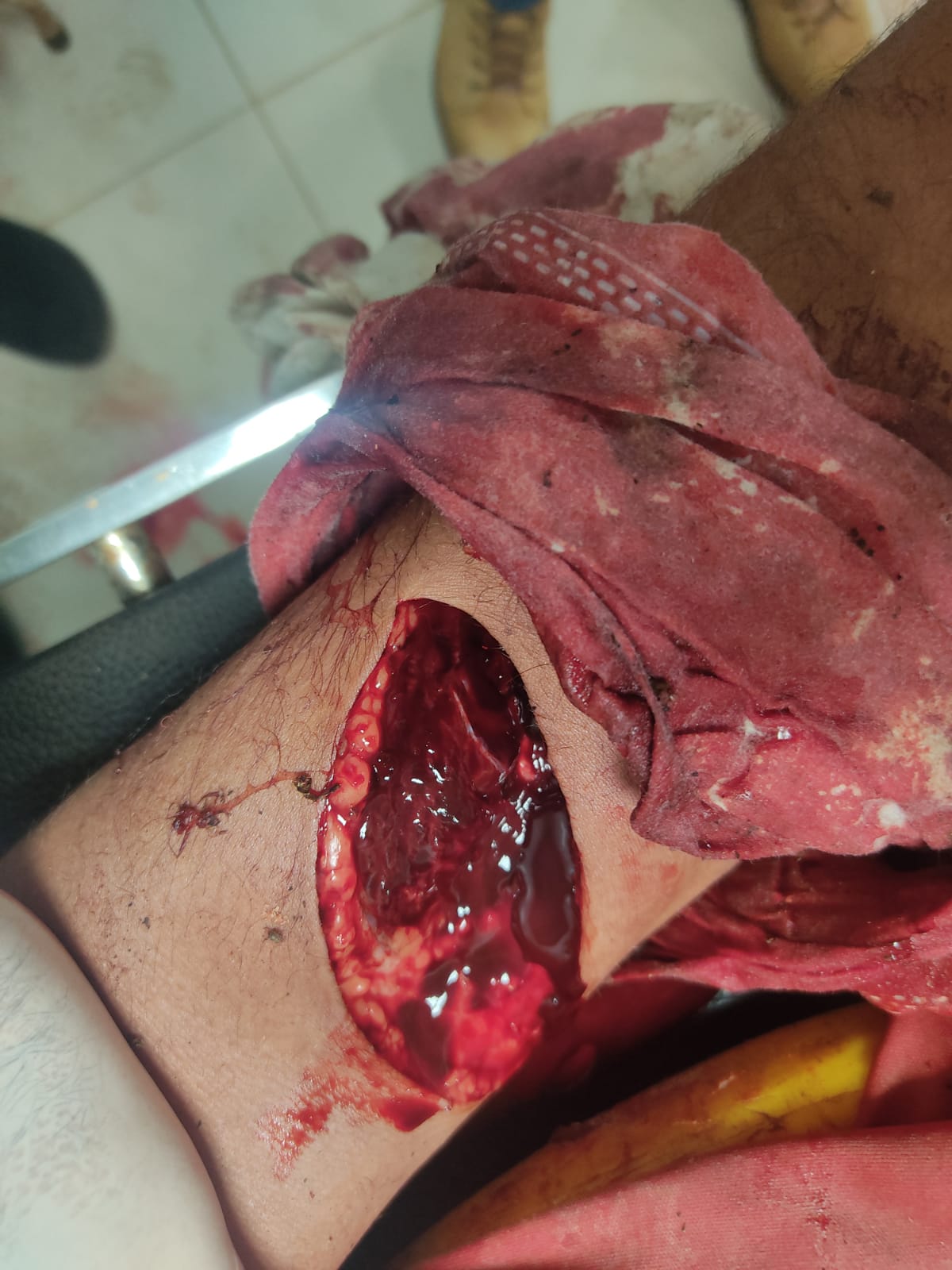 Joven falleció tras chocar por una aplanadora en Pedro Juan.