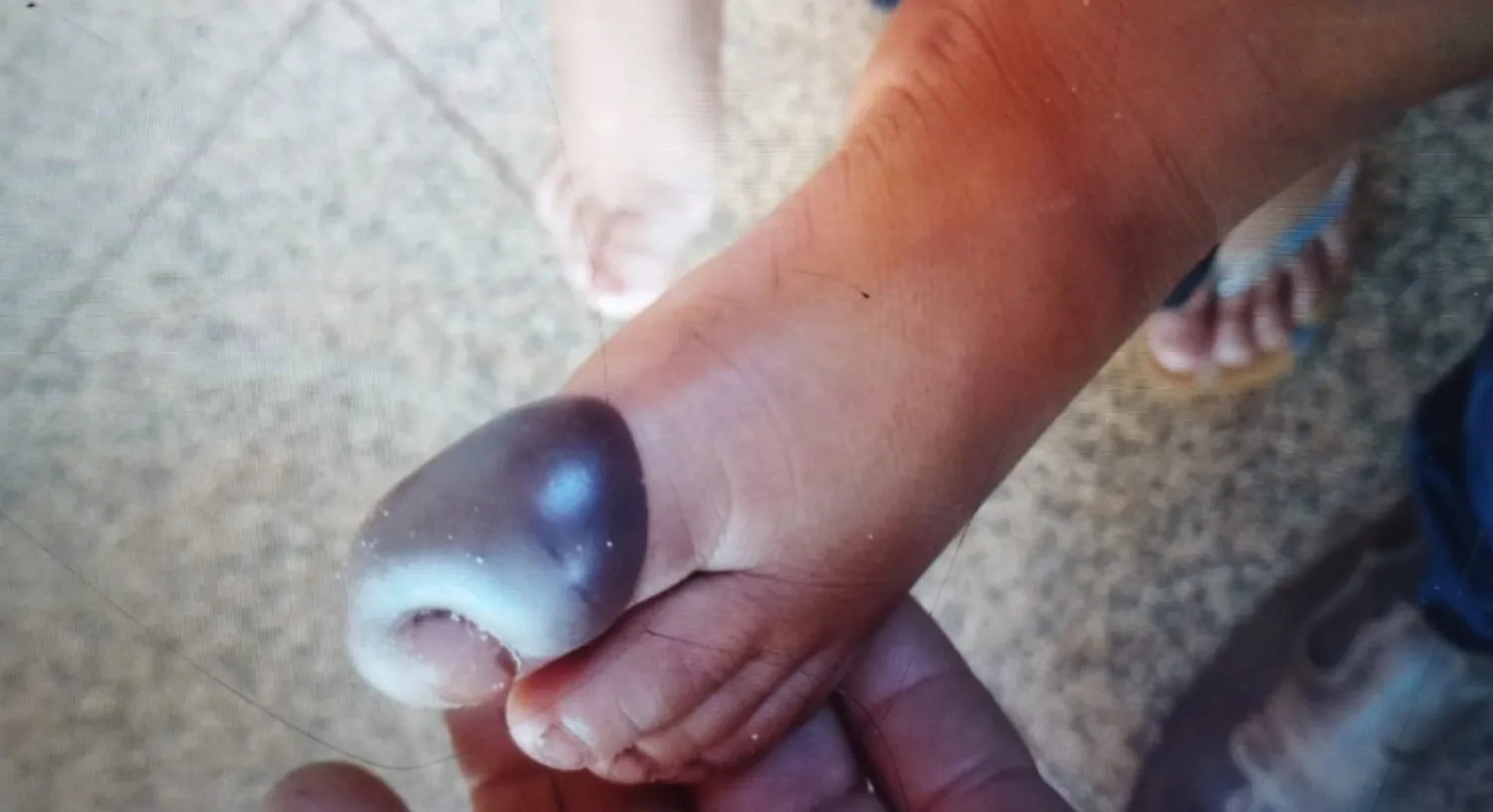 Menor es atacado por una serpiente yarará en Bella Vista Norte y permanece estable