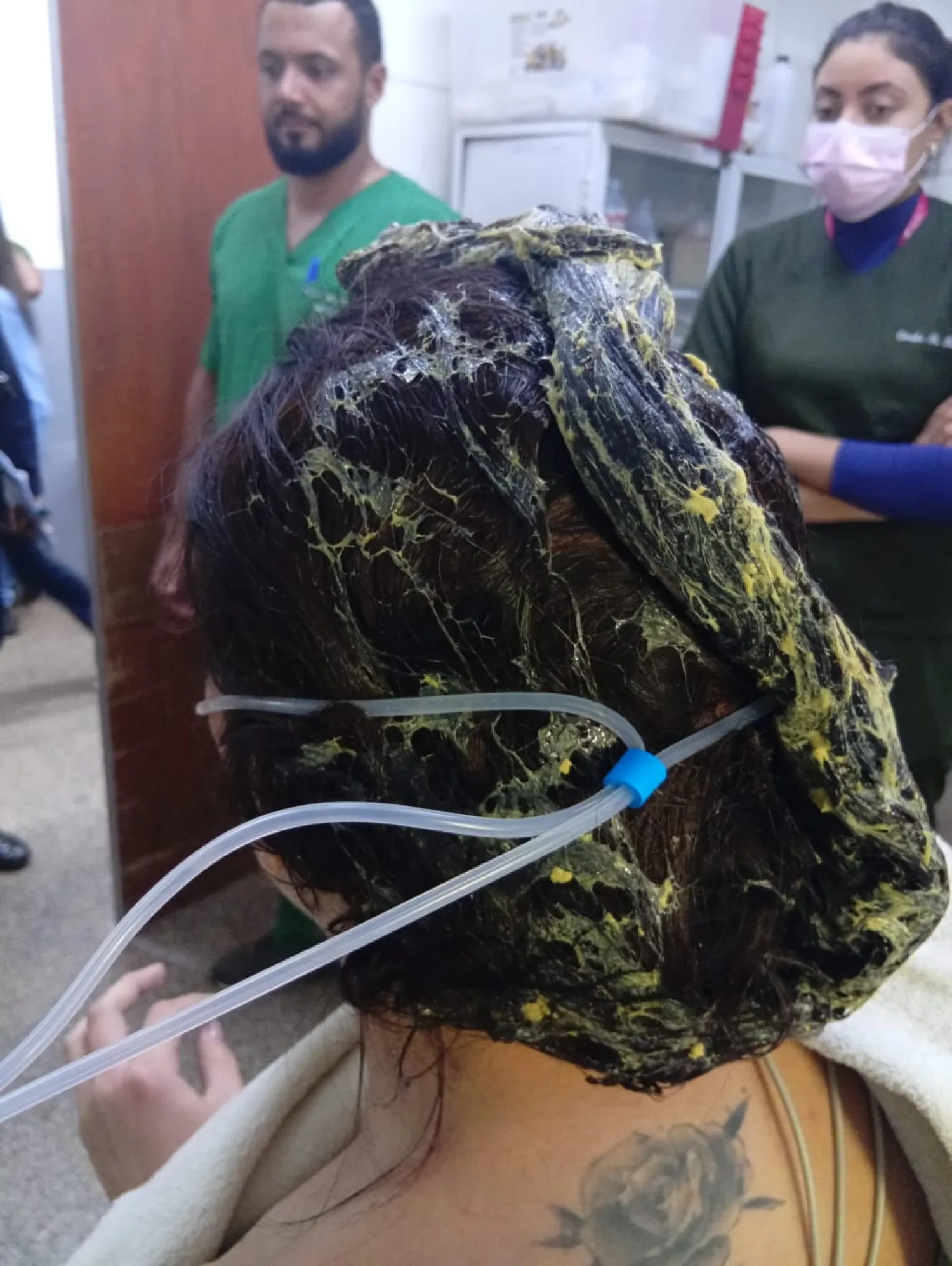 Brasileño derrama cola de zapatero al cabello de su pareja en Pedro Juan